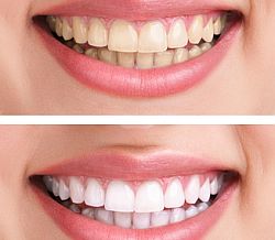 Teeth Whitening