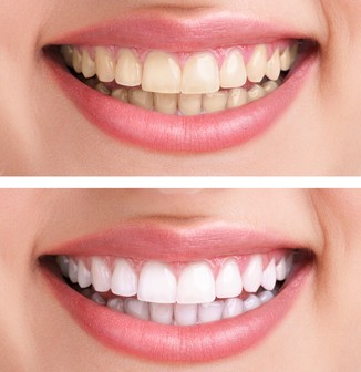 whitening 1