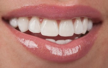 veneers
